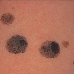 Example of skinLumpsAndBumps
